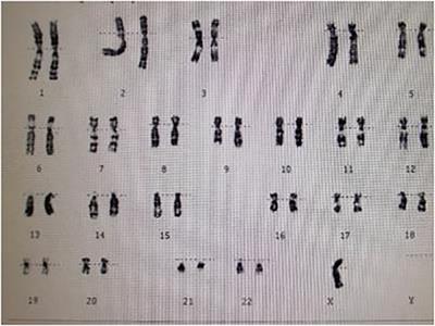 Stent implantation in severe aortic coarctation in a pediatric patient with Turner syndrome: Case report and literature review